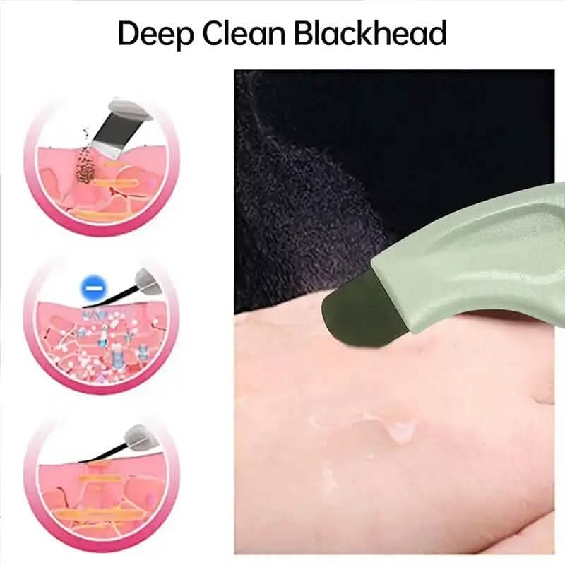 Blackhead Remover Tool Extractor by DailySale